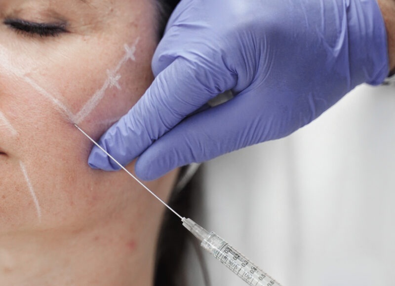 Fillers (Hyaluronic Acid) - Reine Medico-Aesthetics Fillers (Hyaluronic Acid) - Reine Medico-Aesthetics