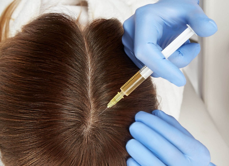 PRP for hair loss - Reine Medico-Aesthetics PRP for hair loss - Reine Medico-Aesthetics