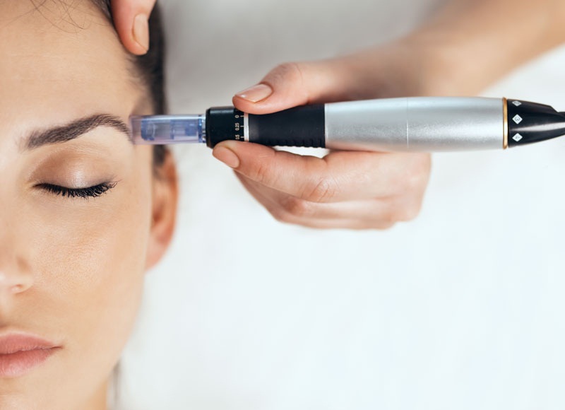 Micro-needling - Reine Medico-Aesthetics Micro-needling - Reine Medico-Aesthetics